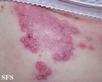 hailey-hailey disease