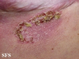 hailey-hailey disease