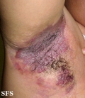 hailey-hailey disease