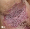hailey-hailey disease