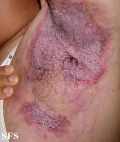 hailey-hailey disease