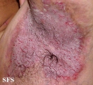 hailey-hailey disease
