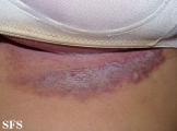 hailey-hailey disease