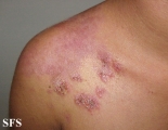 hailey-hailey disease