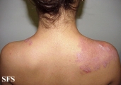 hailey-hailey disease