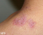 hailey-hailey disease