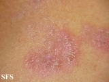 hailey-hailey disease
