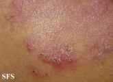 hailey-hailey disease