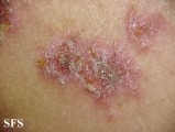 hailey-hailey disease