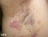 hailey-hailey disease