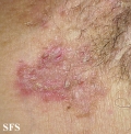 hailey-hailey disease