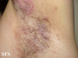 hailey-hailey disease