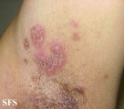 hailey-hailey disease