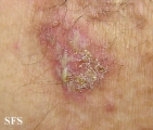 hailey-hailey disease