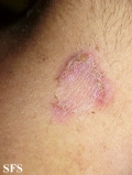 hailey-hailey disease
