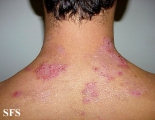 hailey-hailey disease