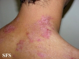 hailey-hailey disease