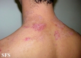 hailey-hailey disease
