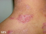hailey-hailey disease