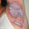 hailey-hailey disease