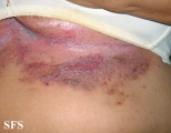 hailey-hailey disease