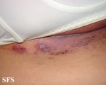 hailey-hailey disease