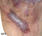 hailey-hailey disease