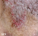 hailey-hailey disease