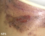 hailey-hailey disease
