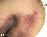 hailey-hailey disease