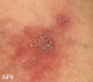 hailey-hailey disease