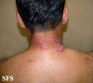 hailey-hailey disease