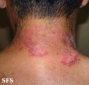 hailey-hailey disease