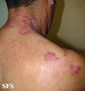 hailey-hailey disease
