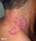 hailey-hailey disease
