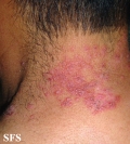 hailey-hailey disease