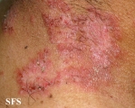 hailey-hailey disease