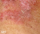 hailey-hailey disease