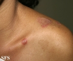hailey-hailey disease