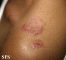 hailey-hailey disease