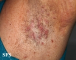 hailey-hailey disease