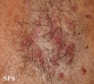 hailey-hailey disease