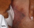 hailey-hailey disease