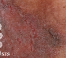 hailey-hailey disease