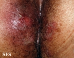 hailey-hailey disease