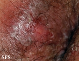 hailey-hailey disease