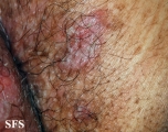 hailey-hailey disease