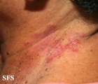 hailey-hailey disease