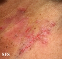 hailey-hailey disease