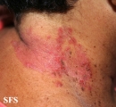 hailey-hailey disease